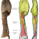 The main tumor mass is at the top of the bone, and can be seen on the 3D reconstruction in yellow; red gray is the normal bone and red denotes the medullary cavity.